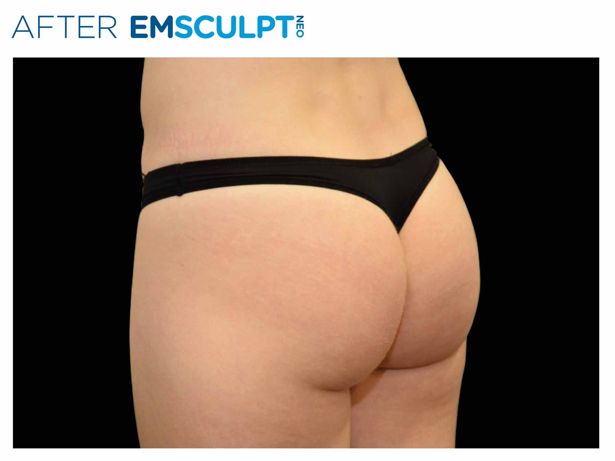 Buttocks after Emsculpt NEO treatment